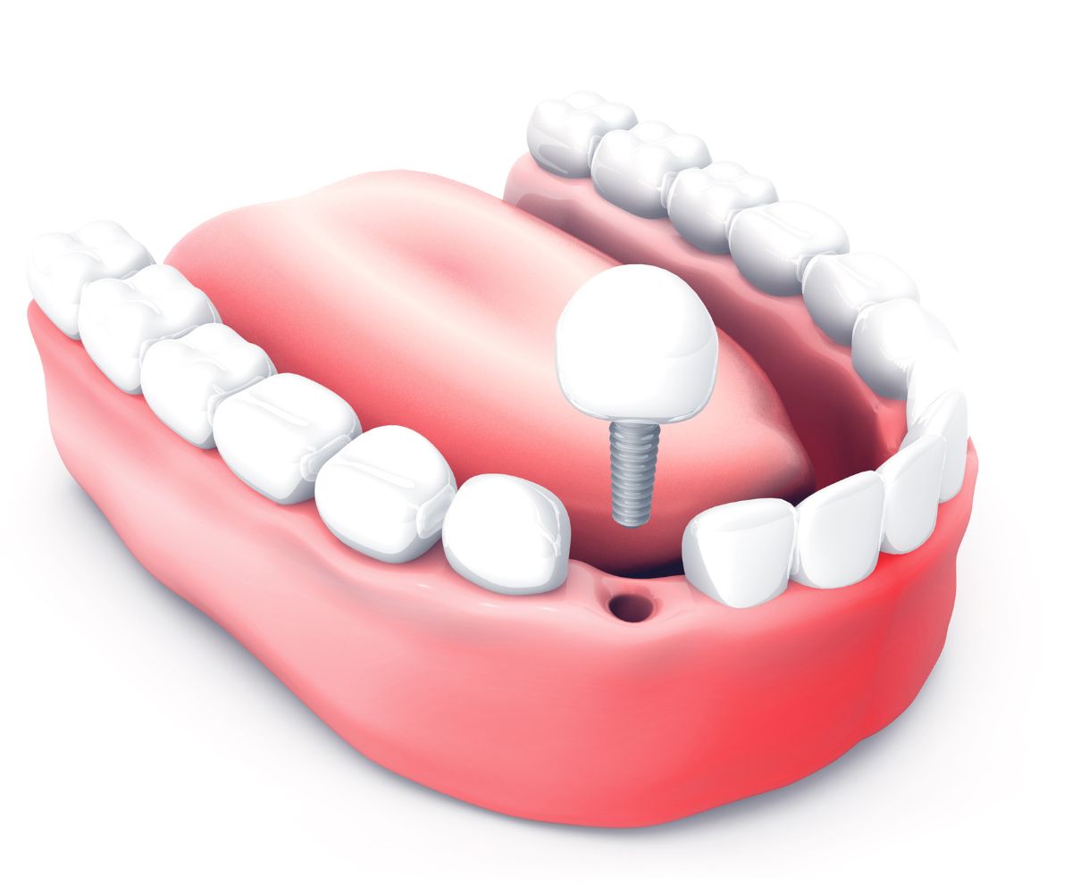 Tipos de Enxerto Ósseo para Implante Dentário